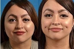 Dimple Creation | Dimpleplasty 4 Before and After Dimple Creation in Dubai