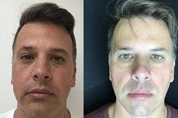 Exilis Treatment Dubai 4 exilis-treatment in dubai
