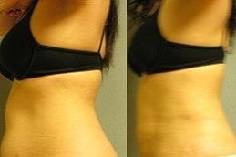 best gps-laser-liposuction in dubai