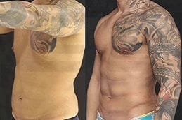 High Definition Liposculpture 6 best high-definition-liposculpture in dubai