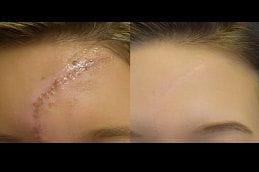 Keloid Treatment 6 best keloid-treatment in dubai