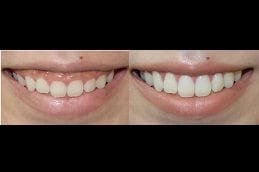 best laser-gum-surgery in dubai
