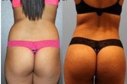 best lipomatic-treatment in dubai