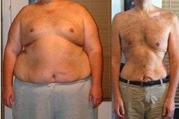 Mini Gastric Bypass 5 best mini-gastric-bypass in dubai