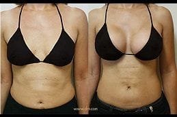 Motiva Breast Implants 4 motiva-breast-implants in dubai