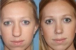 best septoplasty-turbinate-reduction in dubai