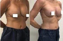 Breast Lift Surgery 5 breast-lift Clinic in Dubai