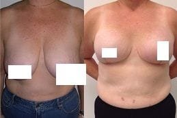 Breast Reconstruction 5 breast-reconstruction in Abu Dhabi