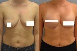 Breast Reconstruction 4 breast-reconstruction in dubai