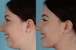 chin-augmentation in dubai