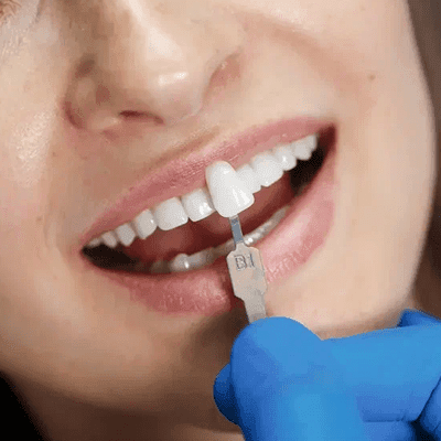 dental veneer dubai