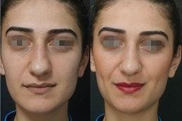 Dimple Creation | Dimpleplasty 5 Dimple Creation in Dubai Before and After