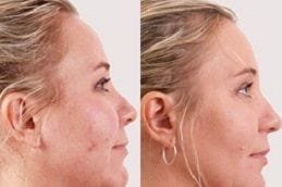 Exilis Treatment Dubai 5 exilis-treatment in Abu Dhabi