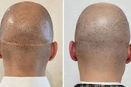 FUT Strip Hair Transplant 4 FUT hair transplant side effects