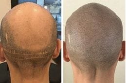 FUT Strip Hair Transplant 5 FUT hair transplant cost
