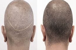 FUT Strip Hair Transplant 6 Fut Before & After fut
