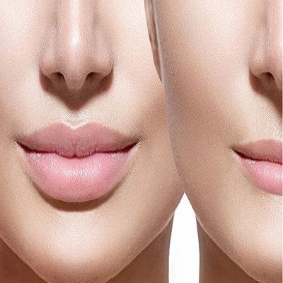 how much volbella filler for lips Cost in dubai