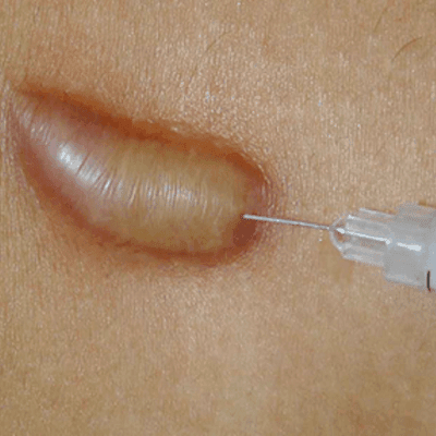 Keloid Scar Injection