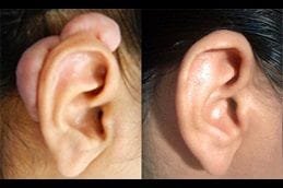 Keloid Treatment 5 keloid-treatment Clinic in Dubai