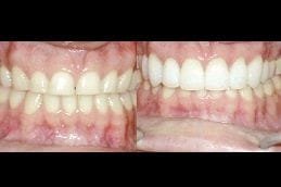 Laser Gum Surgery 3 laser-gum-surgery in Abu Dhabi