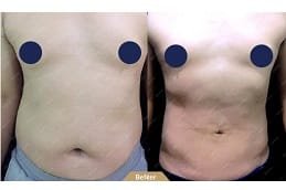 lipomatic-treatment Clinic in Dubai