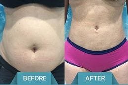lipomatic-treatment in Abu Dhabi