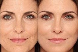 liquid-facelift in dubai