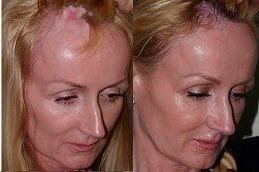 Natural Hairline Treatment 5 natural-hairline-treatment-in-Abu-Dhabi