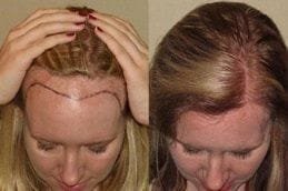 Natural Hairline Treatment 6 natural-hairline-treatment in dubai