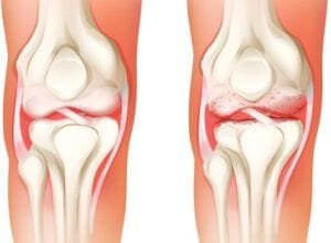 prp for knee