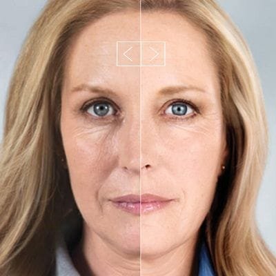 How Much Do Sculptra Dermal Filler Cost?