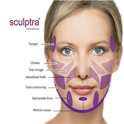 sculptra fillers in dubai