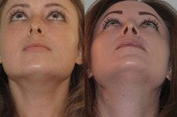 septoplasty-turbinate-reduction Clinic in Dubai