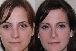 septoplasty-turbinate-reduction in Abu Dhabi