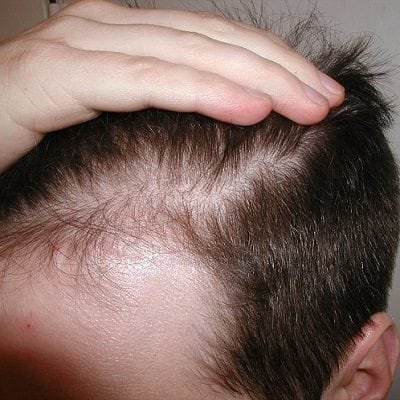 side effects of non surgical hair replacement Dubai & Abu Dhabi