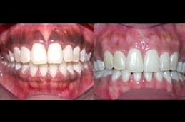 Soft Tissue Dental Laser 3 soft-tissue-dental-laser-Clinic-in-Dubai.
