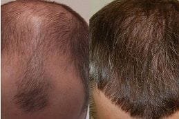 turkish-hair-transplant in dubai
