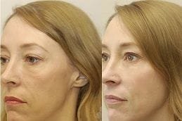vampire-facelift in Abu Dhabi
