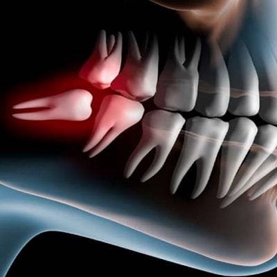 wisom tooth removal