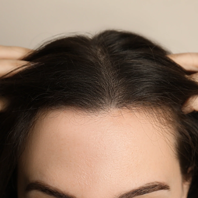Does Hair Transplant Work for Women?