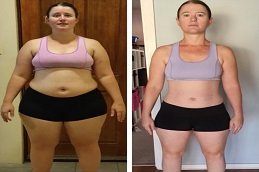 Gastric Band Surgery Dubai