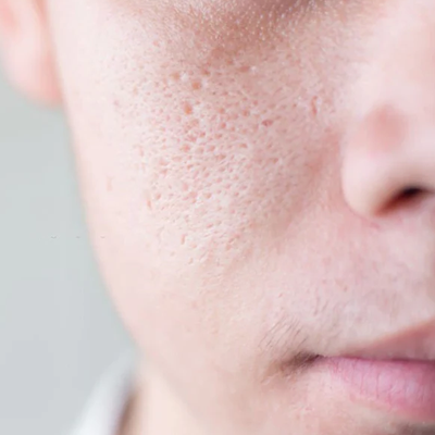 How Do I Reduce the Size of My Pores?