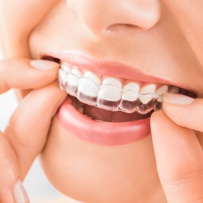 How Long Do I Have to Wear Retainers?