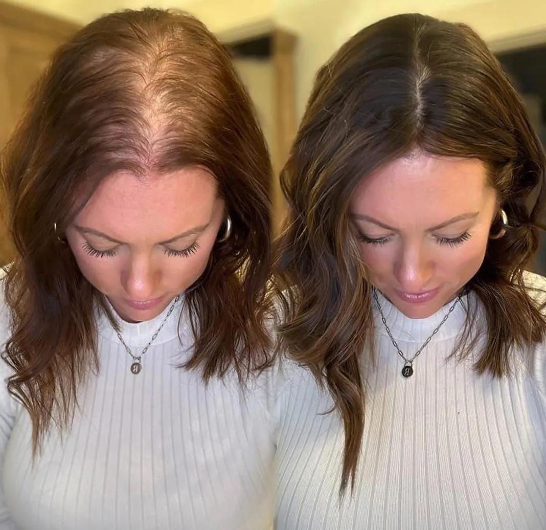 Dynamic Life Clinics 151 Dynamic Life Clinics - Hair Loss Treatment - Before & After