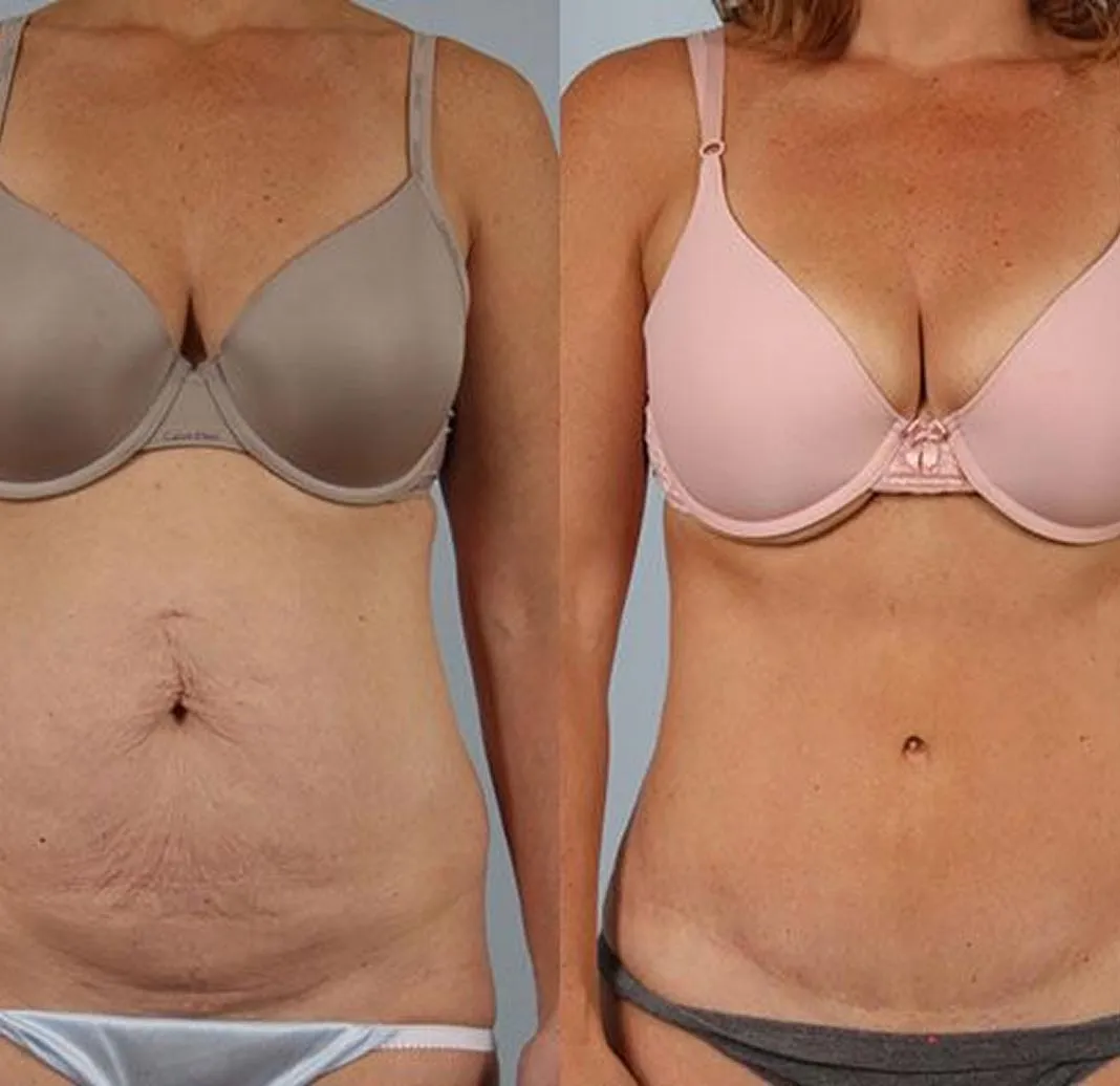 Dynamic Life Clinics 150 Dynamic Life Clinics - Liposuction - Before & After