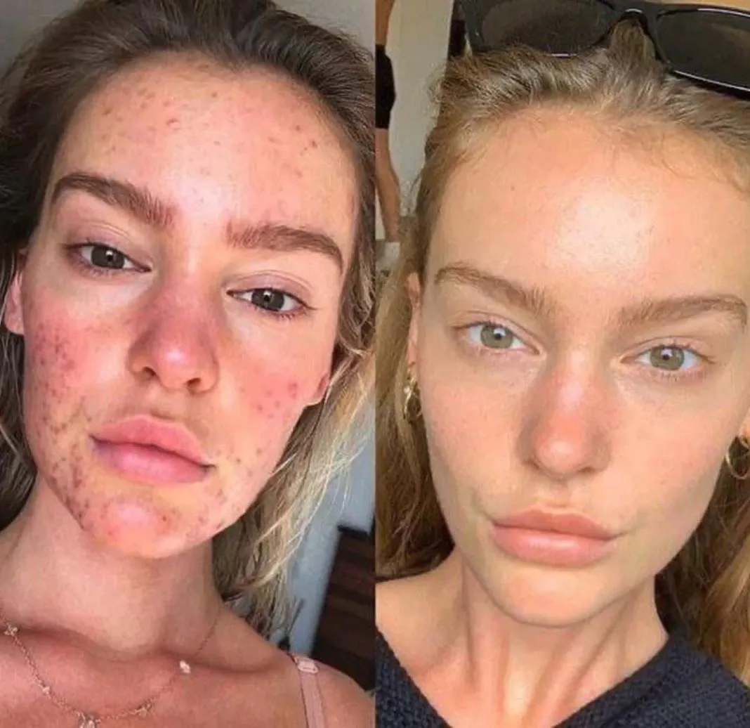Dynamic Life Clinics 148 Dynamic Life Clinics - Acne Treatment - Before & After