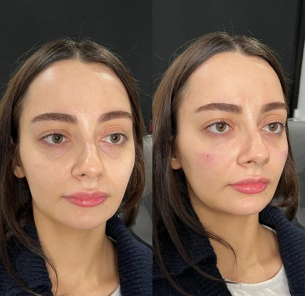 Dynamic Life Clinics 146 Dynamic Life Clinics - Dermal Fillers Injections - Before & After
