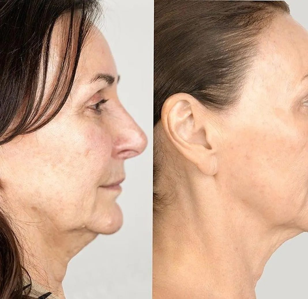 Dynamic Life Clinics 149 Dynamic Life Clinics - Chin Liposuction - Before & After