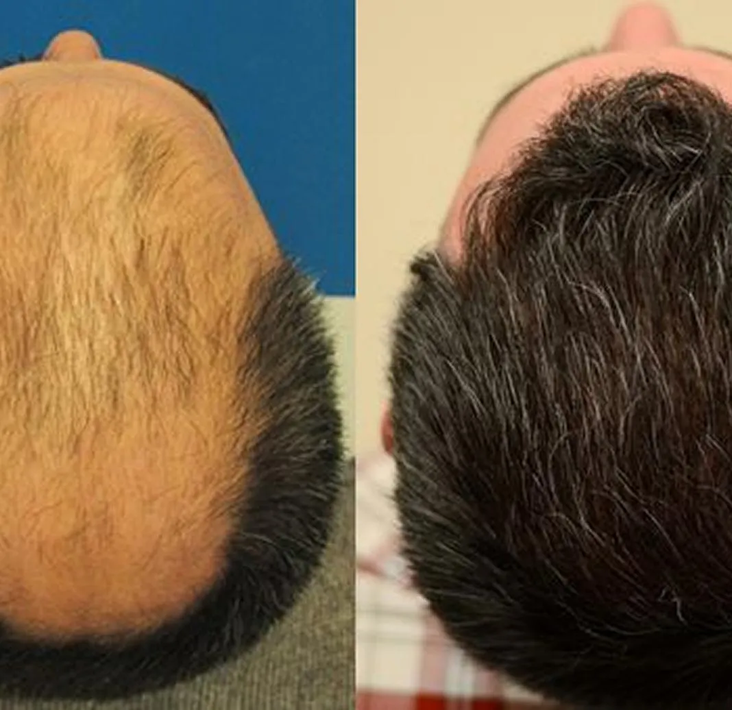 Dynamic Life Clinics 147 Dynamic Life Clinics - Hair Transplant - Before & After