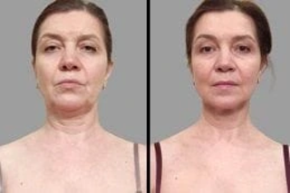Before & After ClearLift laser in Dubai